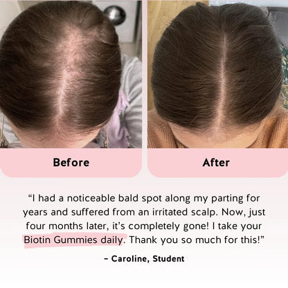 LUMMIE hair growth gummy bears